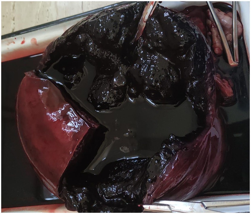 A medical image of a dissected organ, possibly a uterus, showing dark, coagulated blood or clots with a glossy texture. Surgical tools are seen around it, indicating an autopsy or surgical procedure.