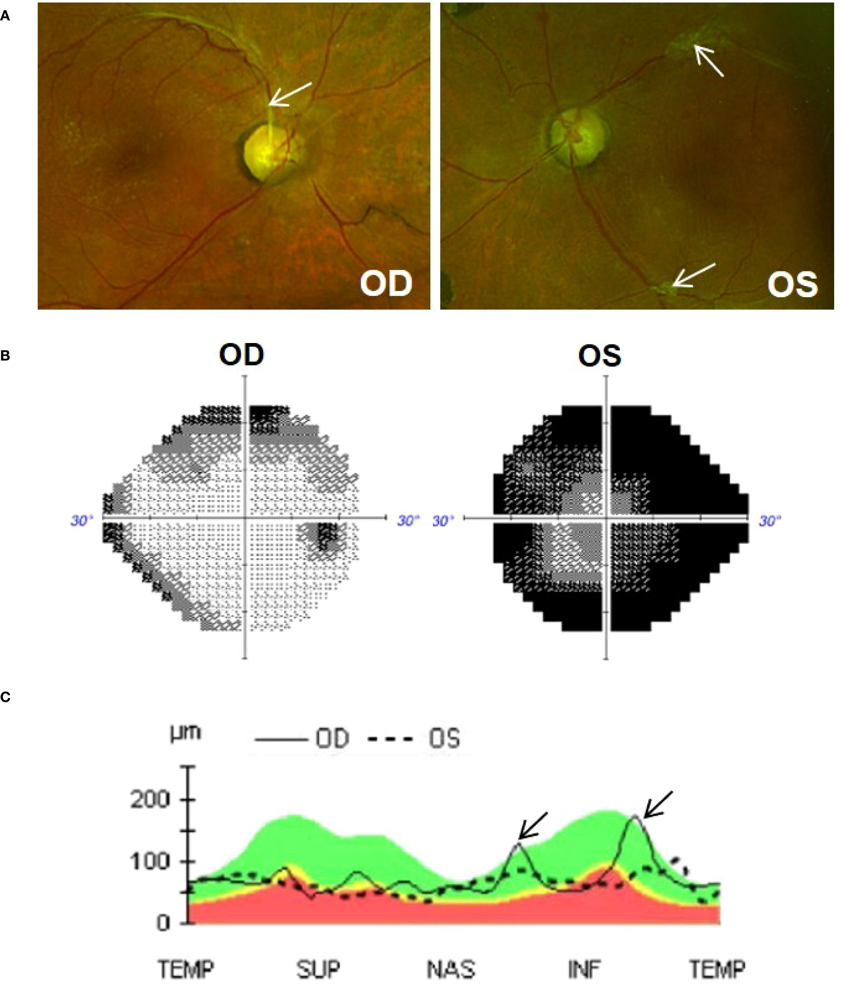 Three-part image related to eye examination. A: Two retinal images labeled OD and OS, with arrows indicating tractional fibrous membranes. B: Visual field test results for OD and OS. C: Graph comparing retinal nerve fibre layer thickness for OD and OS. Arrows highlight regions of RNFL peaks due to traction exerted by a fibrous membrane.