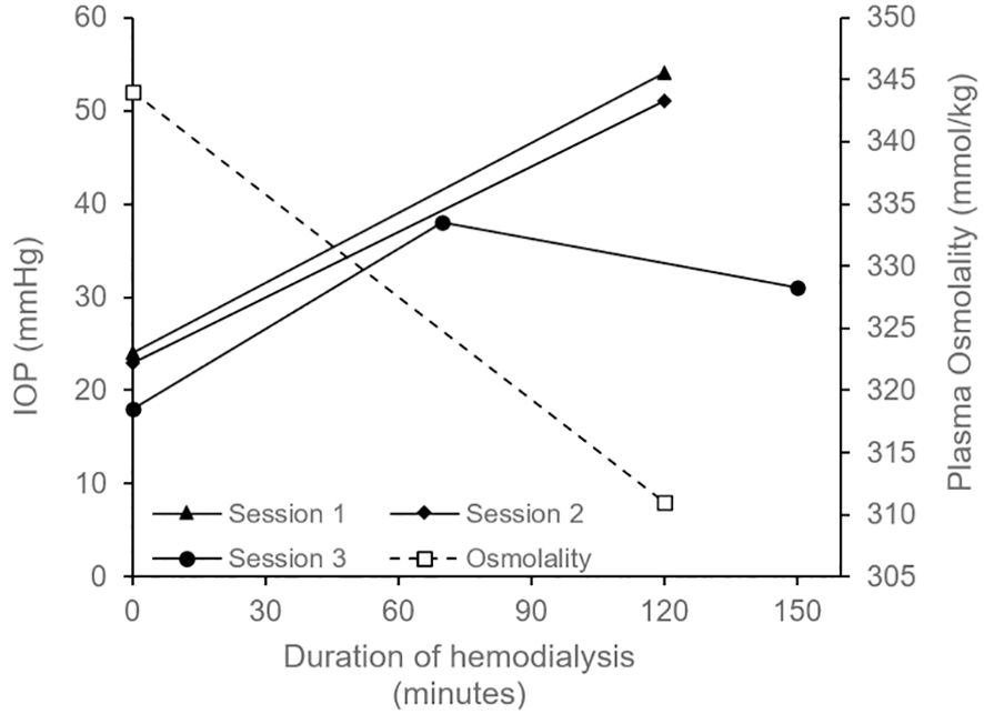 Graph showing intraocular pressure (IOP) and plasma osmolality during hemodialysis over 150 minutes. IOP (mmHg) for sessions one, two, and three increases steadily. Plasma osmolality (mmol/kg) decreases after dialysis.
