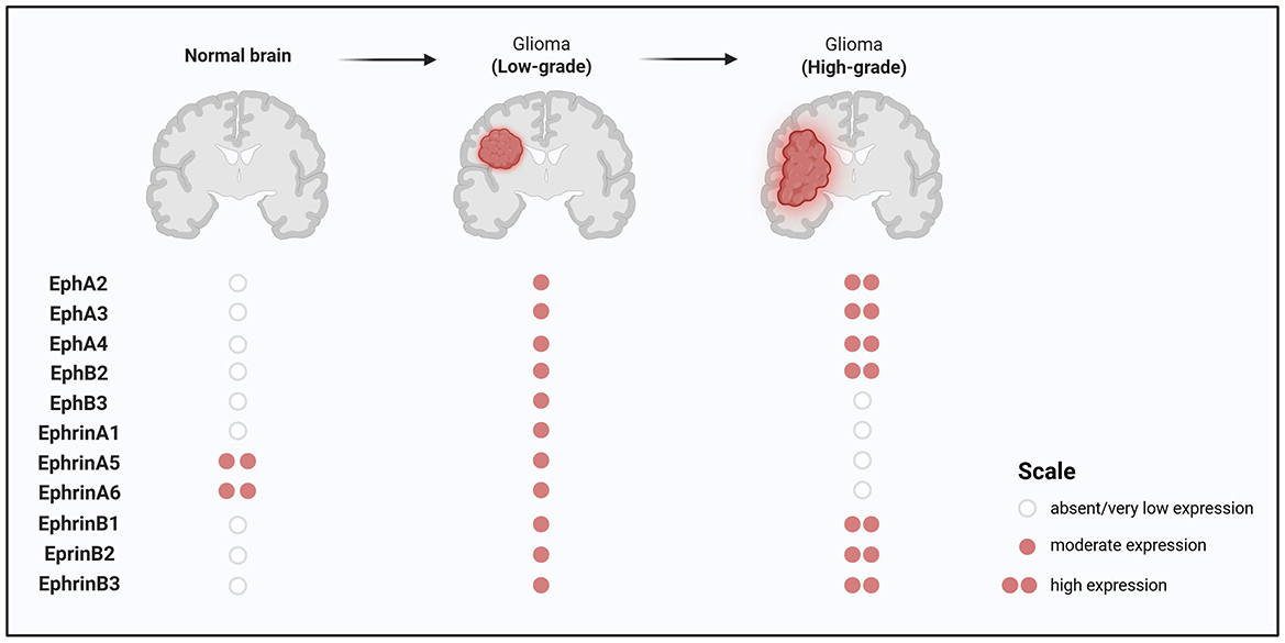 Illustration showing a brain with the medulloblastoma region highlighted. Two activation pathways are described: Sonic Hedgehog (SHH) and Non-Sonic Hedgehog (non-SHH). SHH involves EphB1, EphB4, EphrinA4, EphrinB3. Non-SHH involves EphA2, EphA8, EphB1, EphrinA1, EphrinA3, EphrinB3. It notes that the expression patterns of Eph and ephrin receptors in SHH and non-SHH medulloblastomas are linked to tumor-promoting functions and enhanced dissemination.