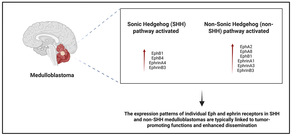 Diagram showing brain progression from normal to low-grade and high-grade glioma, with corresponding expression levels of Eph and Ephrin proteins. Normal brain shows low expression. Low-grade glioma shows moderate-to-high expression of multiple proteins. High-grade glioma exhibits high expression, particularly of EphA2, EphB2, EphrinA1, EphrinA5, and EphrinA6. Expression levels are indicated by color-coded dots: empty for low, pink for moderate, and red for high.