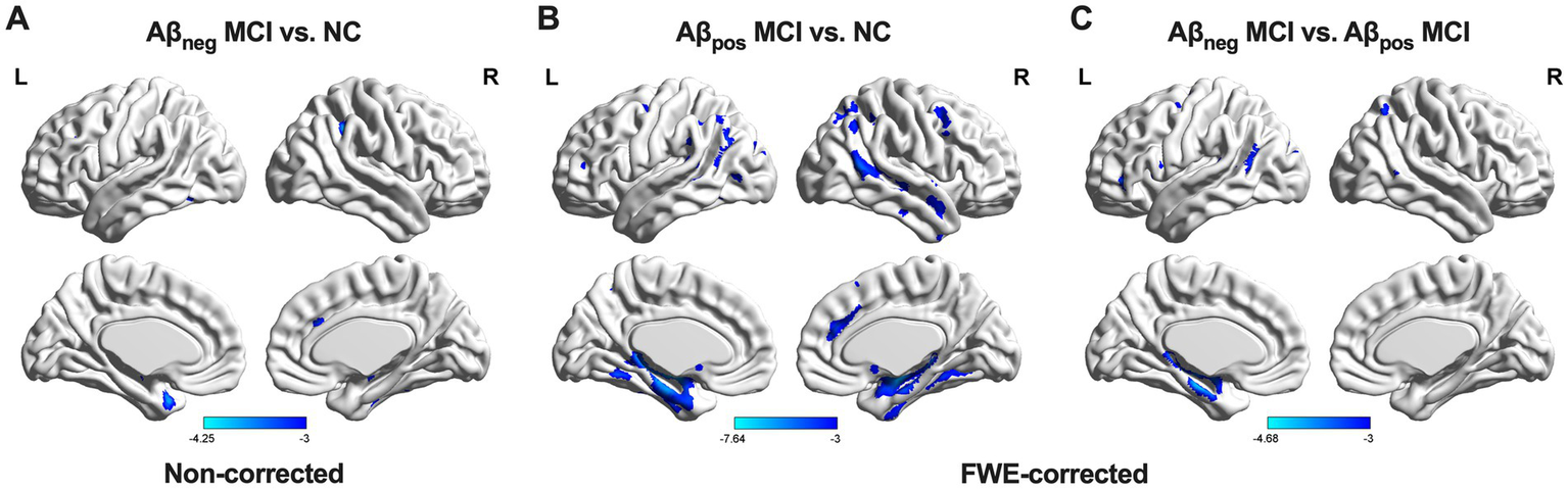 Three sets of brain images comparing amyloid-beta negative and positive mild cognitive impairment (MCI) against normal controls (NC) and each other. Blue areas indicate statistical significance, with non-corrected images on the left and family-wise error (FWE)-corrected on the right. Each set includes lateral and medial views, labeled with left (L) and right (R) hemispheres. A color bar displays value ranges from negative three to approximately negative eight.