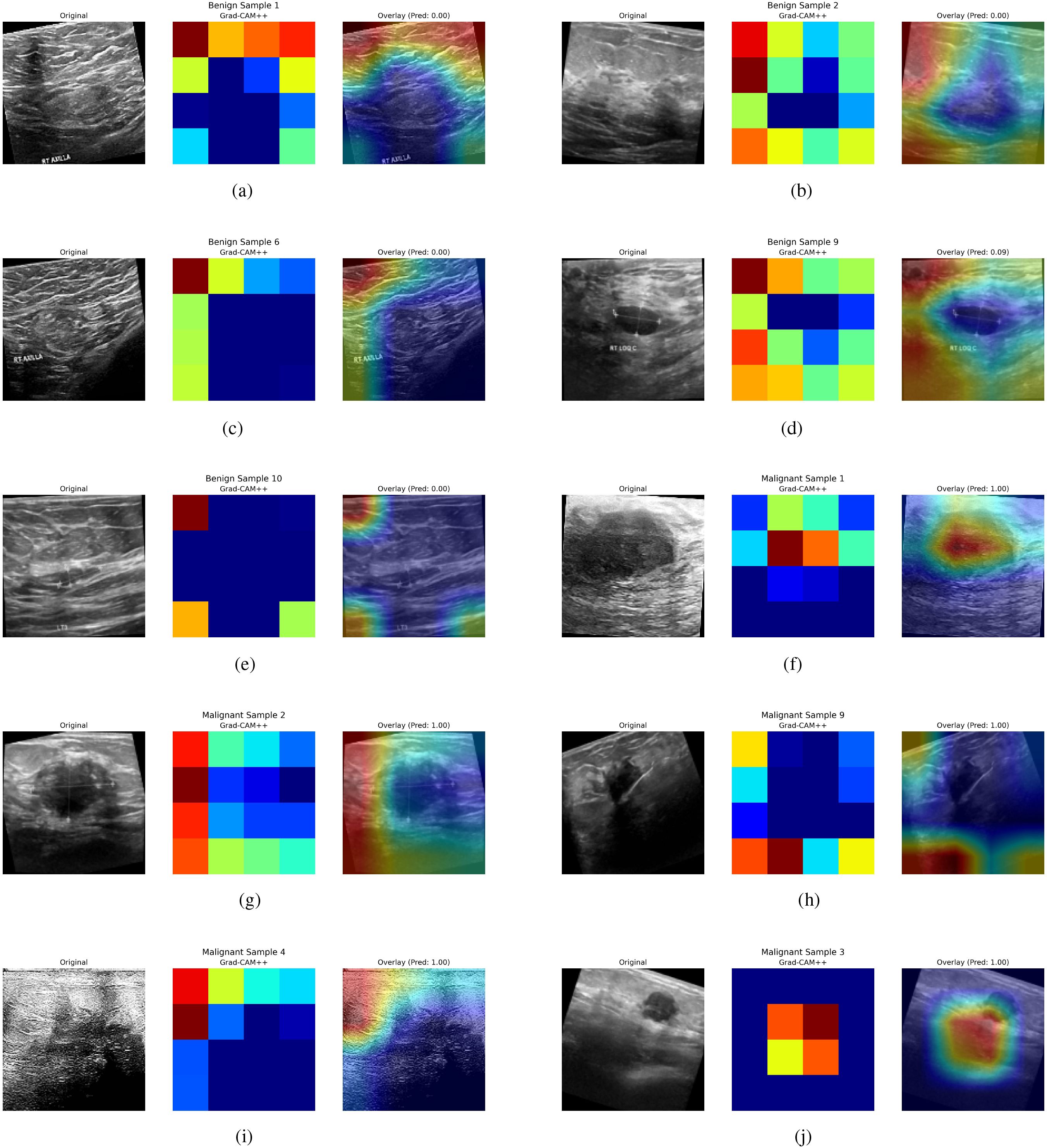 Ultrasound images set showing benign and malignant samples annotated with corresponding Grad-CAM++ visualizations. Each row pairs an original ultrasound image with its Grad-CAM++ heatmap and overlay, predicting tissue states. Benign samples (a, c, e) have lower prediction values, depicted with cooler colors, while malignant samples (f, g, i, j) exhibit higher prediction values, marked by warmer colors. Each pair demonstrates how the heatmap highlights areas of interest in diagnosing benign versus malignant conditions, providing visual interpretation for machine learning predictions.