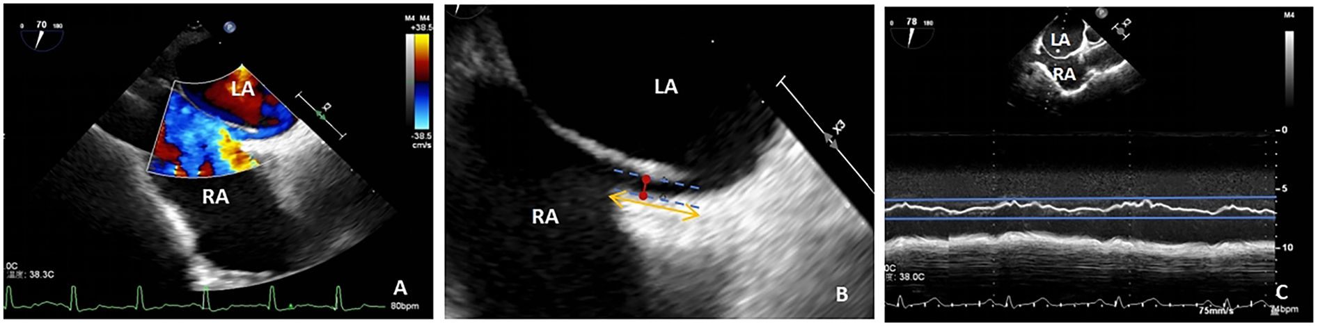 Three ultrasound images showing the heart's atria. Panel A displays color Doppler imaging with labeled left atrium (LA) and right atrium (RA). Panel B illustrates flow measurement with directional arrows between RA and LA. Panel C shows M-mode echocardiography with LA and RA labels, featuring wave patterns and measurement scales.