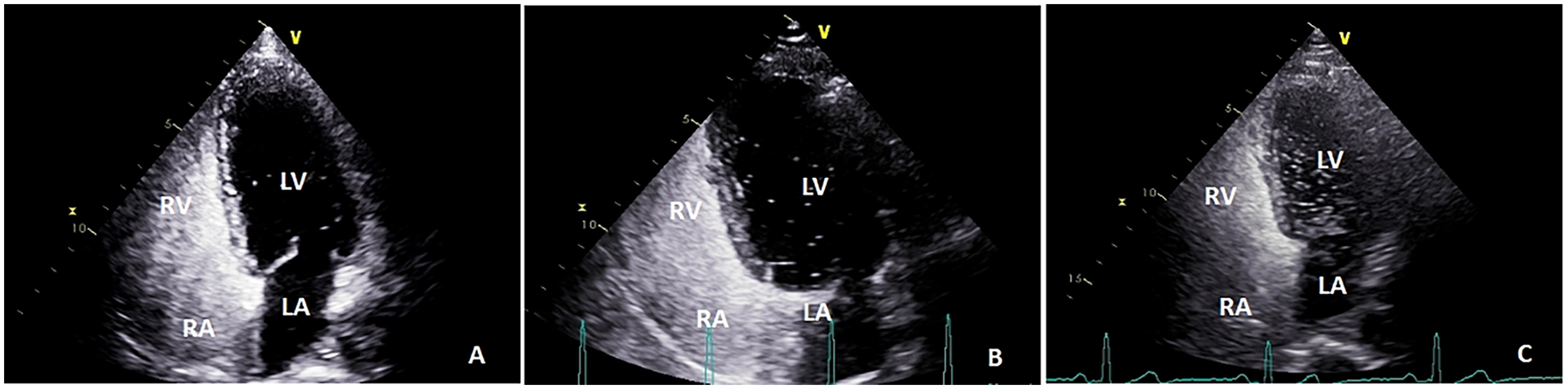 Trio of echocardiogram images showing different heart views labeled A, B, and C. Panel A displays left ventricle, right ventricle, left atrium, and right atrium. Panel B focuses on left ventricle and atriums. Panel C highlights similar heart features with added EKG lines at the bottom.