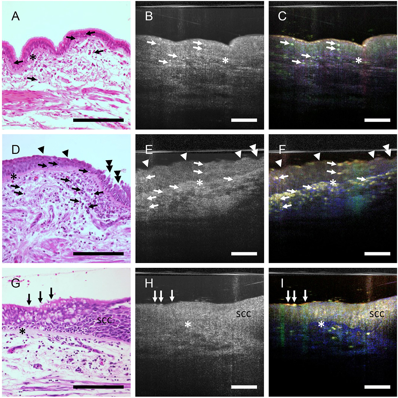 Microscopic and imaging analysis of lung tissue. Panel A shows a histological section with arrows and an asterisk indicating specific tissue features. Panels B and C show corresponding OCT images with arrows and an asterisk. Panels D, E, and F display another set of tissue sections and OCT images, highlighting differences with arrows, asterisks, and arrowheads. Panels G, H, and I present a histological section and imaging results of squamous cell carcinoma, marked by arrows and an asterisk, with “SCC” labeled on imaging views. Each panel has a scale bar for reference.