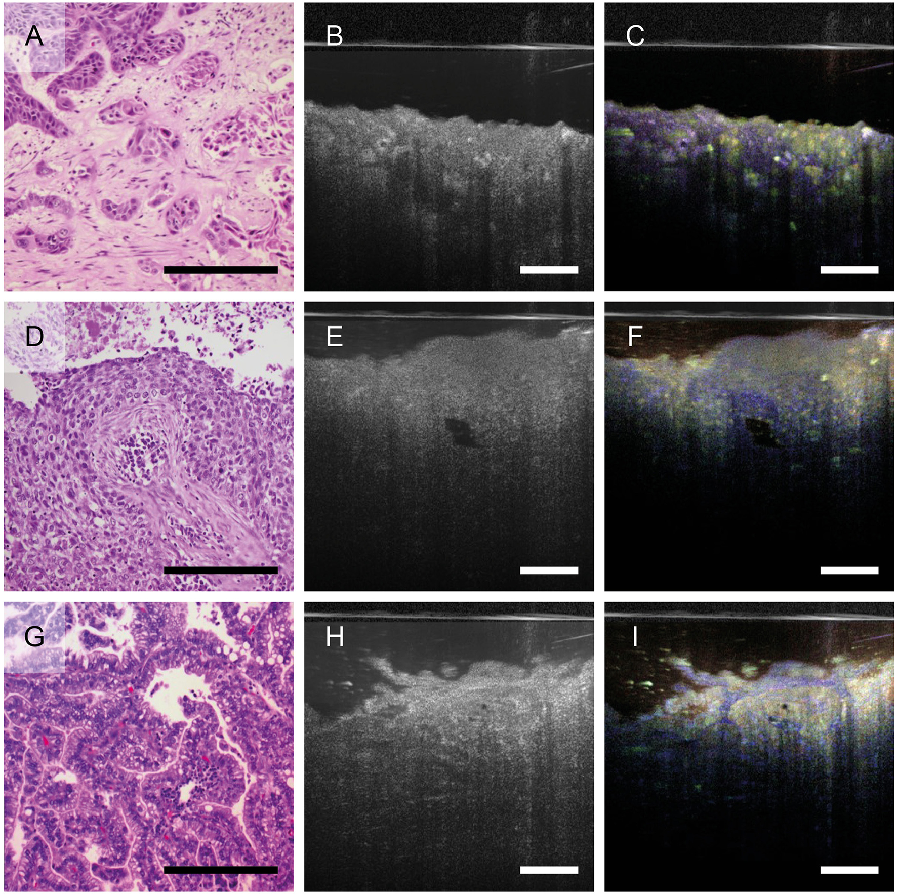 Panel A shows a histological image with a form of lung cancer. Panel B is a grayscale OCT image, and C is its corresponding dynamic OCT
images version. Panels D, E, and F repeat this structure with different tumor in the lung, as do panels G, H, and I. Each OCT image highlights structures that
are also seen in the histological images. Scale bars are visible in each image.
