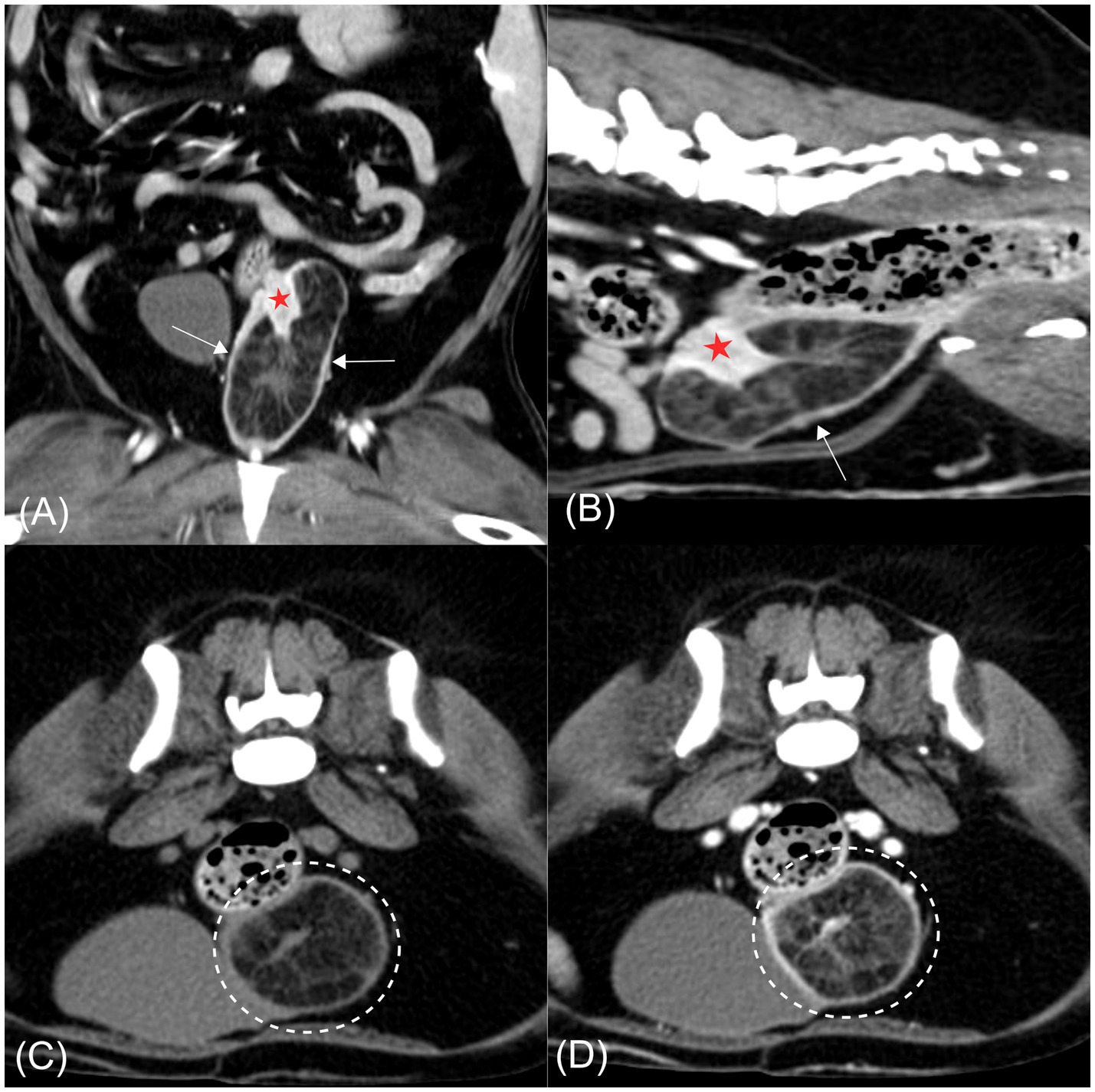 Four-panel computed tomography (CT) images of the caudal abdomen. Panels (A) and (B) show post-contrast coronal and sagittal views of the lesion (asterisk) within the caudal reproductive tract. Panels (C) and (D) display axial pre- and post-contrast views. The dashed circles highlight a well-defined, fat-attenuating lesion that remains hypoattenuating even after contrast administration. Arrows delineate the lesion boundaries and adjacent anatomical structures.
