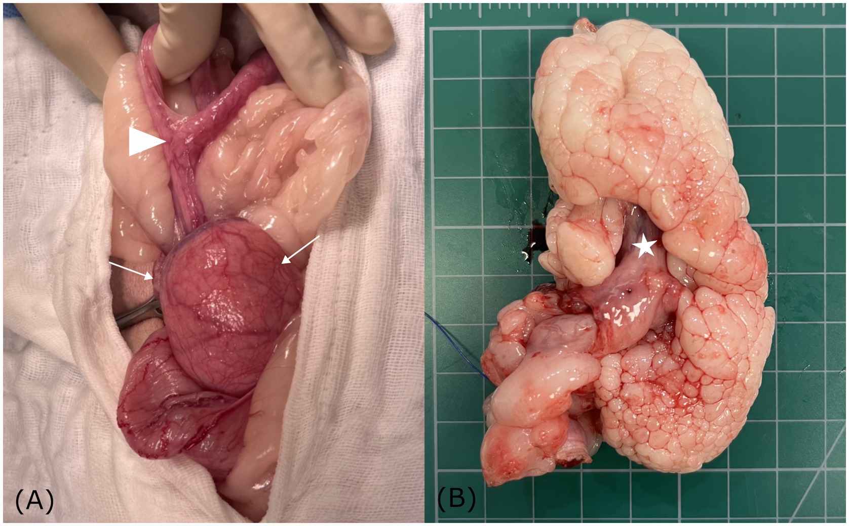 Panel A shows the intraoperative appearance of a polypoid mass protruding from the cervix, smooth and pale-yellow with mild vascularity (arrows). Panel B presents the resected mass on a surgical grid with a ruler for scale, demonstrating a lobulated, encapsulated surface with a yellowish cut section. These images depict the gross morphology and surgical findings of the cervical polyp with lipomatousdifferentiation prior to histopathologic evaluation.