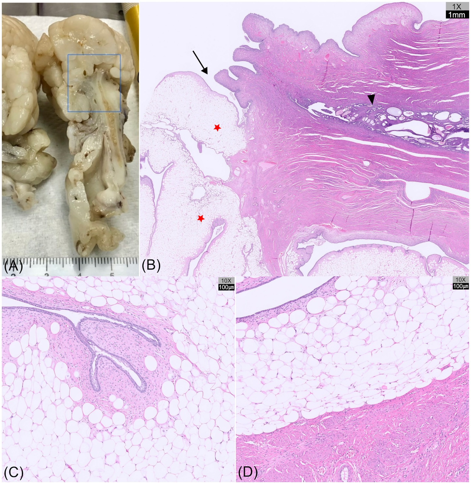 Panel A displays the longitudinally dissected specimen showing yellow to white tissue components. Panel B shows a low-magnification (1×) hematoxylin and eosin (H&E) stained histologic section demonstrating mixed fibrous, smooth-muscle, and adipose tissue. Panels (C) and (D) provide higher-magnification (10×) H&E images revealing intermingled smooth-muscle bundles and mature adipocytes separated by fine fibrous stroma. Arrows and stars indicate representative regions of lipomatous differentiation and collagenous connective tissue.