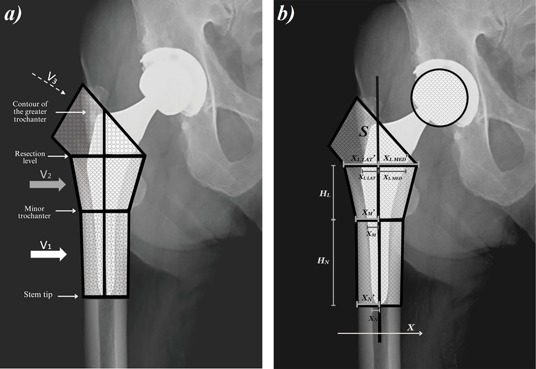 X-ray images of a hip joint showing a femoral prosthesis with labeled sections. Image (a) highlights the greater trochanter, resection level, minor trochanter, and stem tip. Image (b) shows dimensions and stress points labeled as \\(S\\), \\(X_L\\), \\(X_M\\), \\(X_N\\), and others with corresponding measurements \\(H_L\\) and \\(H_N\\) indicated.
