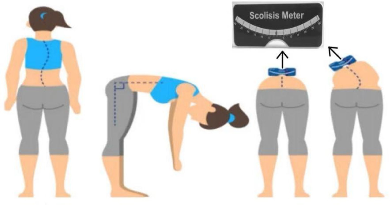 Illustration showing a person standing straight, bending forward, and from two rear views to demonstrate scoliosis assessment. A scoliometer is used to measure spinal curvature, shown with arrows.