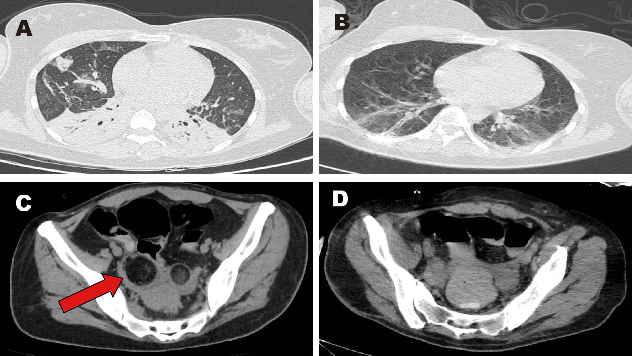 CT scans displaying four panels labeled A, B, C, and D. Panels A and B show lung images with differences in tissue density. Panel C highlights an area with a red arrow. Panel D shows a similar abdominal slice without emphasis.