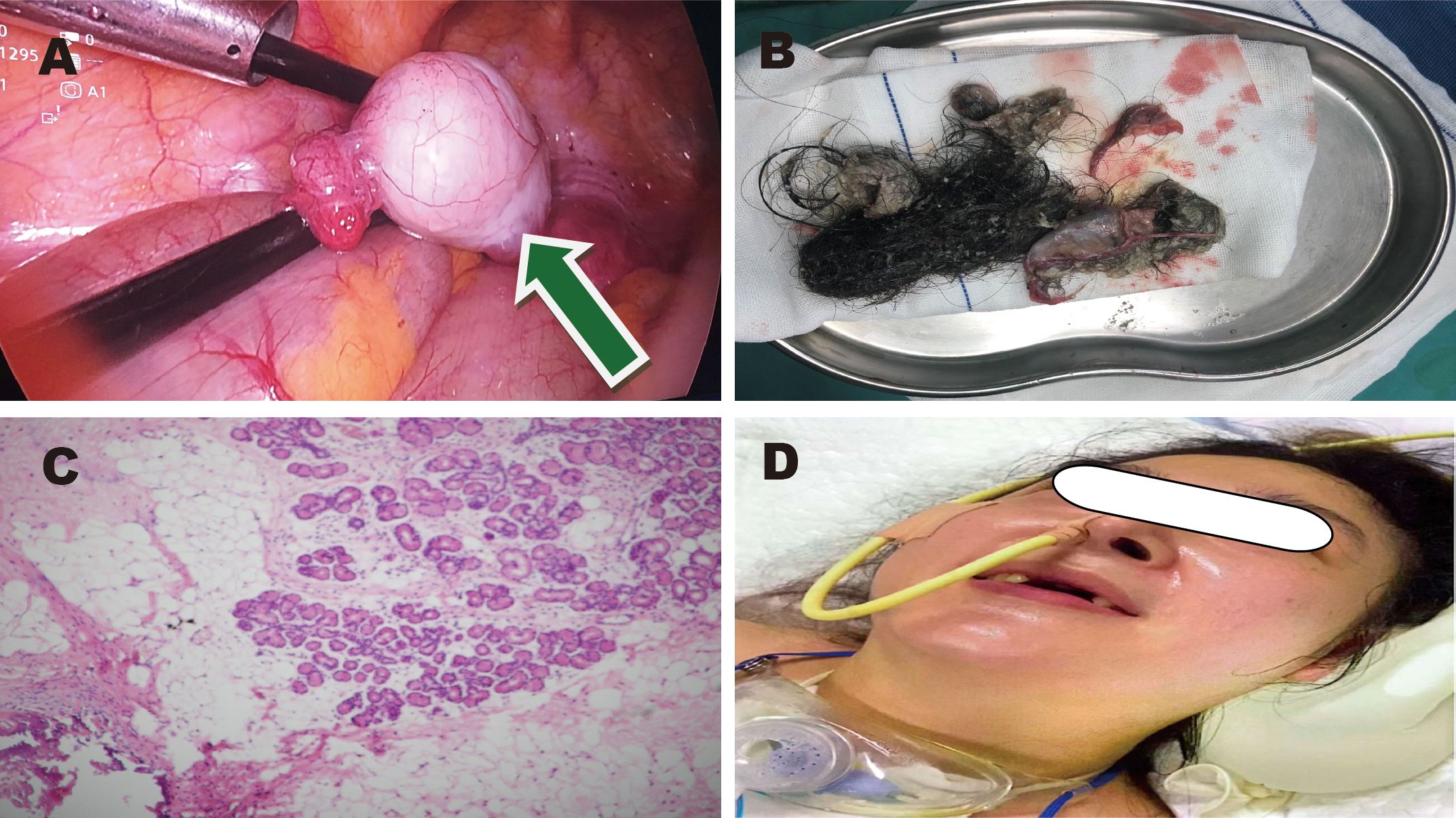 A series of medical images: A) A laparoscopic view of an ovarian cyst being surgically removed. B) A surgical tray containing excised material, possibly including hair and tissue. C) A microscopic view of tissue with visible cellular structures stained for examination. D) A person lying on a medical bed with a nasogastric tube, face obscured for privacy.