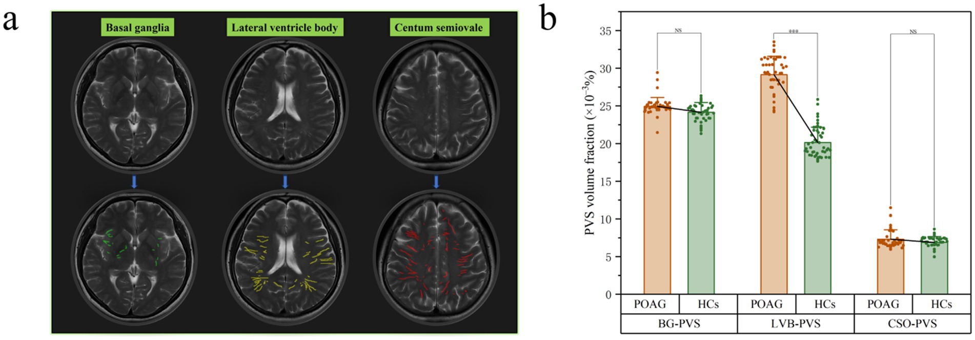 Brain MRI scans with highlighted basal ganglia, lateral ventricle body, and centrum semiovale in the first image. The second image shows a bar graph comparing perivascular space (PVS) volume fractions between POAG and HC groups, indicating significant differences in some areas.