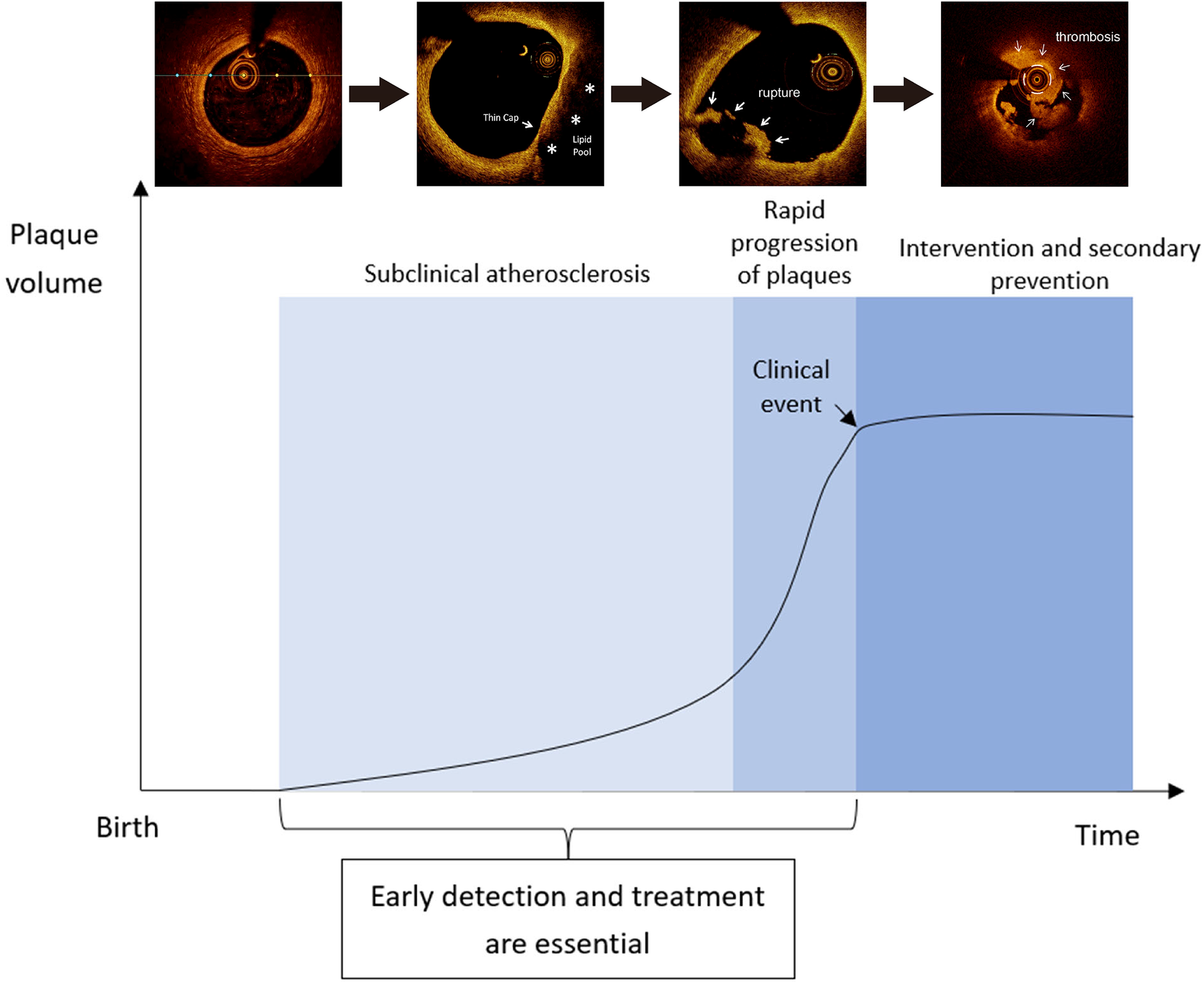 Diagram illustrating the progression of atherosclerosis from a normal vessel through various stages of plaque development (stages I to VI), including lipids, foam cells, and calcification. The stages transition from clinically silent to overt with potential rupture and thrombosis leading to hemorrhage.