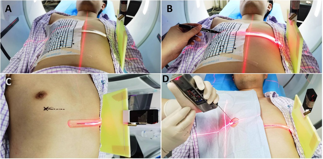 Sequence of images showing a medical procedure involving laser alignment for a patient in a CT scanner. Image A: A patient lies under a CT scanner with a marked grid on their abdomen. Image B: An individual uses a pen for precise markings on the grid. Image C: Marks and laser alignment on the patient's side, indicating incision or procedure points. Image D: A close-up of a person holding a medical tool, guided by laser lines converging at a marked spot on the patient’s abdomen.