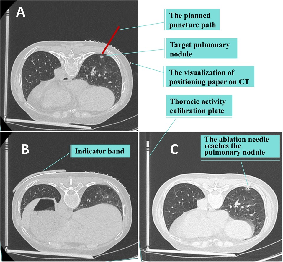 CT scans are labeled A, B, and C, showing different stages of needle positioning for a pulmonary procedure. Image A displays labels for the planned puncture path, target pulmonary nodule, visualization of positioning paper on CT, and thoracic activity calibration plate. Image B highlights an indicator band. Image C shows the ablation needle reaching the pulmonary nodule.