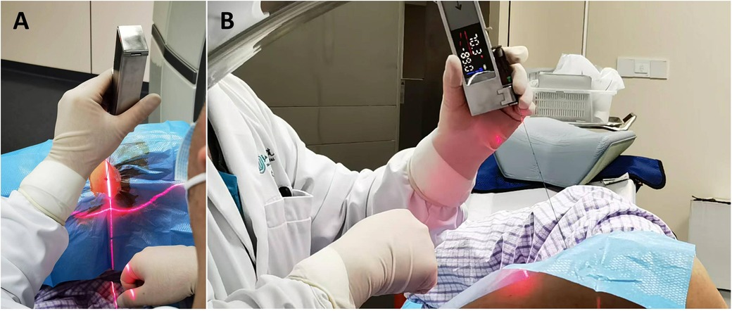 A two-panel image shows a medical procedure involving a laser device. In panel A, a gloved hand holds a laser over a patient's covered skin, emitting red light. In panel B, another view of the practitioner holding the device, displaying digital readings.