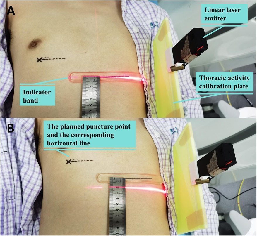 Two images show a person's torso with medical equipment for a procedure. \n\nIn image A, a linear laser emitter projects a laser line from the thoracic activity calibration plate onto the skin, intersecting an indicator band next to a marked point with a ruler measuring the distance.\n\nIn image B, the laser indicates the planned puncture point and corresponding horizontal line, highlighting alignment for accuracy.