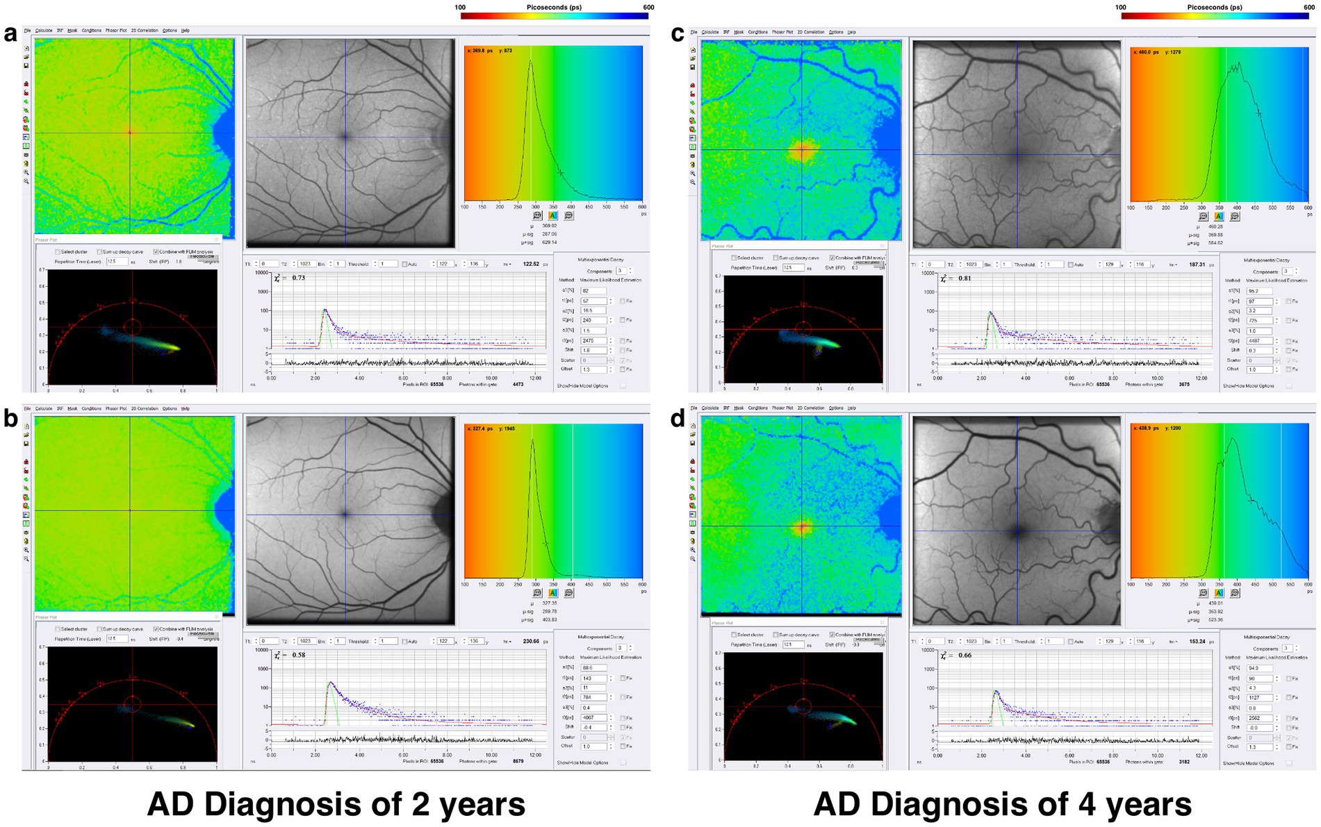 Four panels labeled “a” to “d” show retinal imaging around the macular region, with the same data elements as in Figure 4. Color gradients tend toward blue in the SSC and green in the LSC, with more blue and green in the 4-year patient. Histograms show prolonged fluorescence lifetimes in both SSC and LSC, more pronounced than in the 2-year patient.
