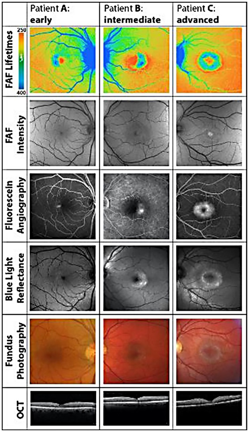 A series of eye imaging studies for three patients at different stages of macular telangiectasia type 2. Each column represents a patient: A (early), B (intermediate), and C (advanced). Images include FAF lifetimes, FAF intensity, fluorescein angiography, blue light reflectance, fundus photography, and OCT scans. Color maps of FAF lifetimes show the most changes in the early-stage patient compared with other imaging modalities.