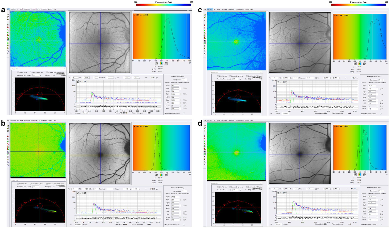 Four panels labeled “a” to “d” show retinal imaging around the macular region, with the same data elements as in Figure 4. Color gradients tend toward blue in the SSC and green in the LSC, with more blue and green in the 18-year patient. Histograms show prolonged fluorescence lifetimes in both SSC and LSC that are more broadened compared with healthy controls.