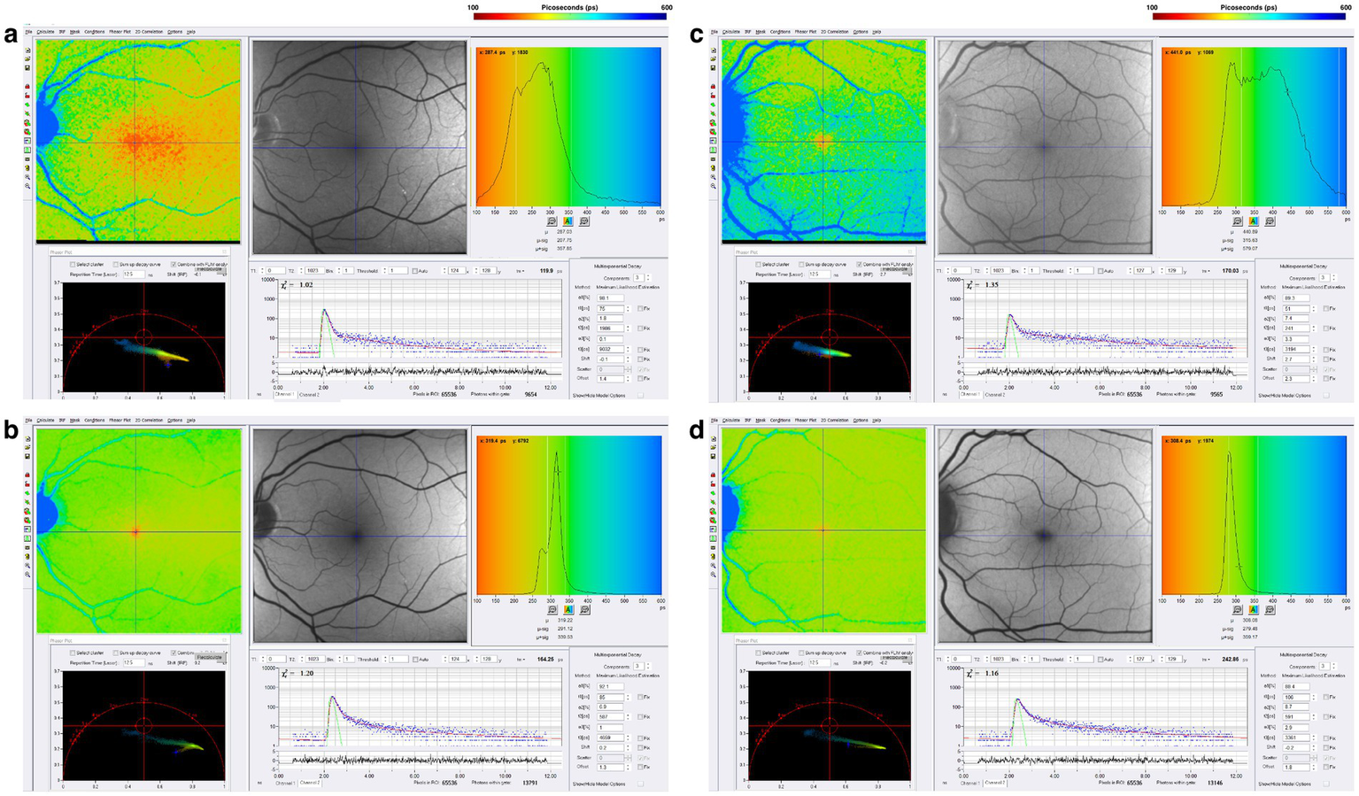 Four panels labeled “a” to “d” show retinal imaging around the macular region, with the same data elements as in Figure 4. FLIO data demonstrate prolonged fluorescence lifetimes mainly in the SSC of both RRMS and SPMS patients. Color gradients show more blue in the SSC of the SPMS patient, while the other panels display slightly abnormal color distributions.
