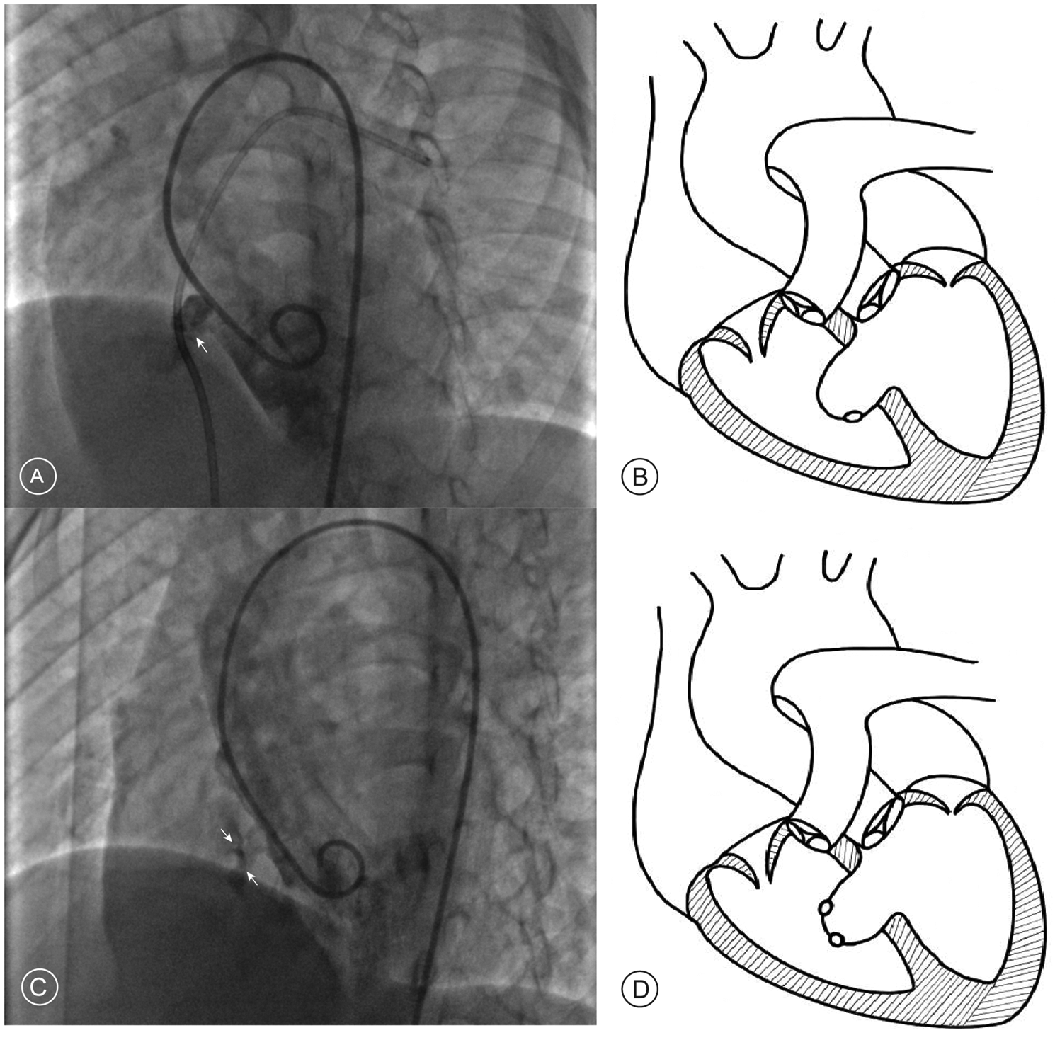X-ray images labeled A and C show catheters placed near the heart. Diagrams labeled B and D depict corresponding anatomical structures of the heart, illustrating catheter placements.