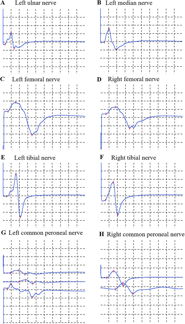 Graphs showing nerve conduction studies for various nerves. Panels A to H depict the left ulnar, left median, left femoral, right femoral, left tibial, right tibial, left common peroneal, and right common peroneal nerves, respectively. Each graph contains a blue waveform on a grid, illustrating electrical activity.