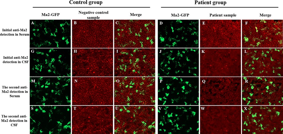 Fluorescent microscopy images comparing anti-Ma2 detection. The control and patient groups are shown in columns with Ma2-GFP, negative or patient samples, and merged images. Rows display initial and second detections in serum and cerebrospinal fluid (CSF). Green indicates Ma2-GFP, red is negative or patient samples. Merged images highlight cellular localization.