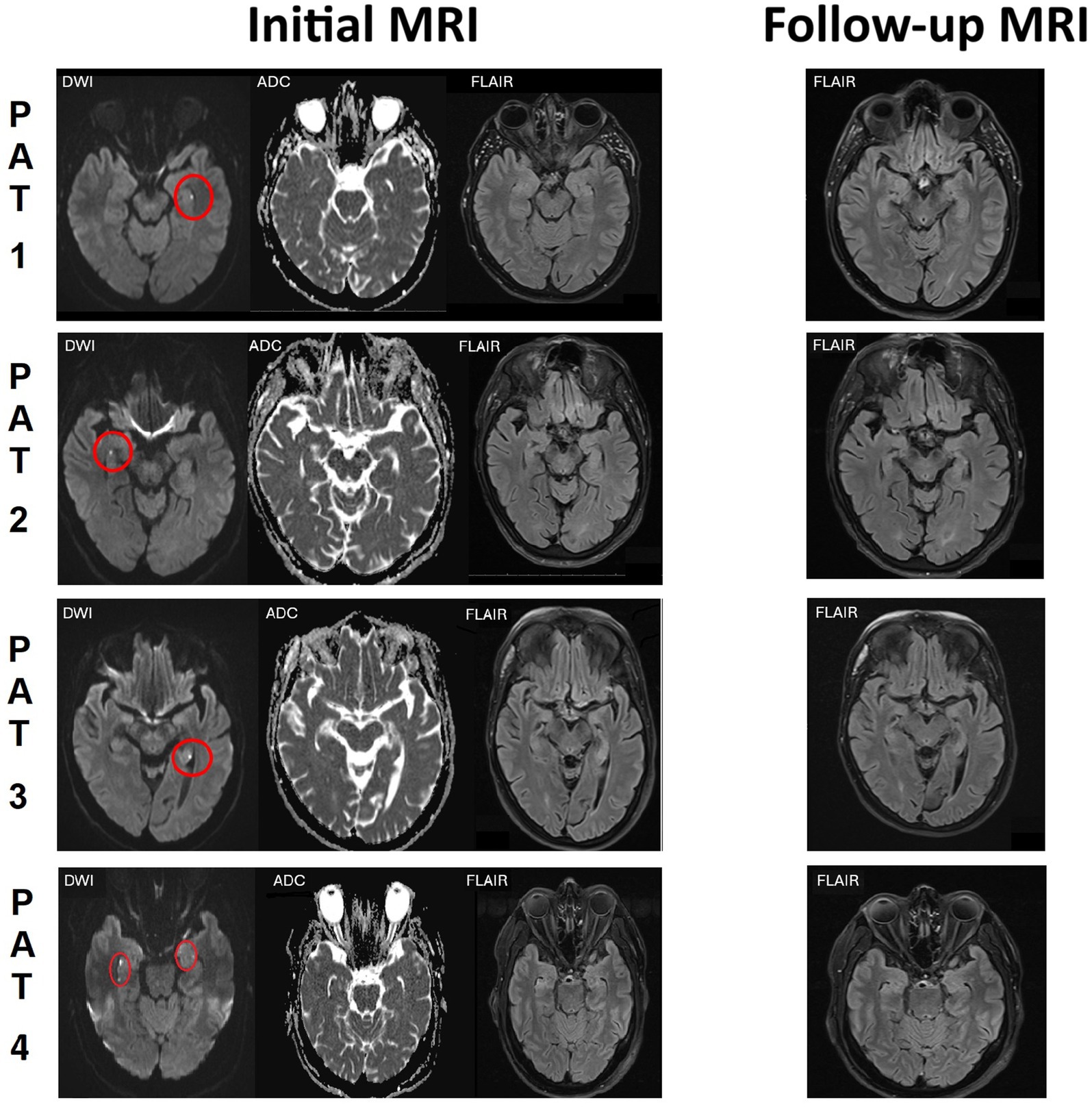 Initial and follow-up MRI scans for four patients labeled PAT 1 to PAT 4. Initial scans include DWI, ADC, and FLAIR images, with abnormalities circled in red on DWI images. Follow-up scans show only FLAIR images.