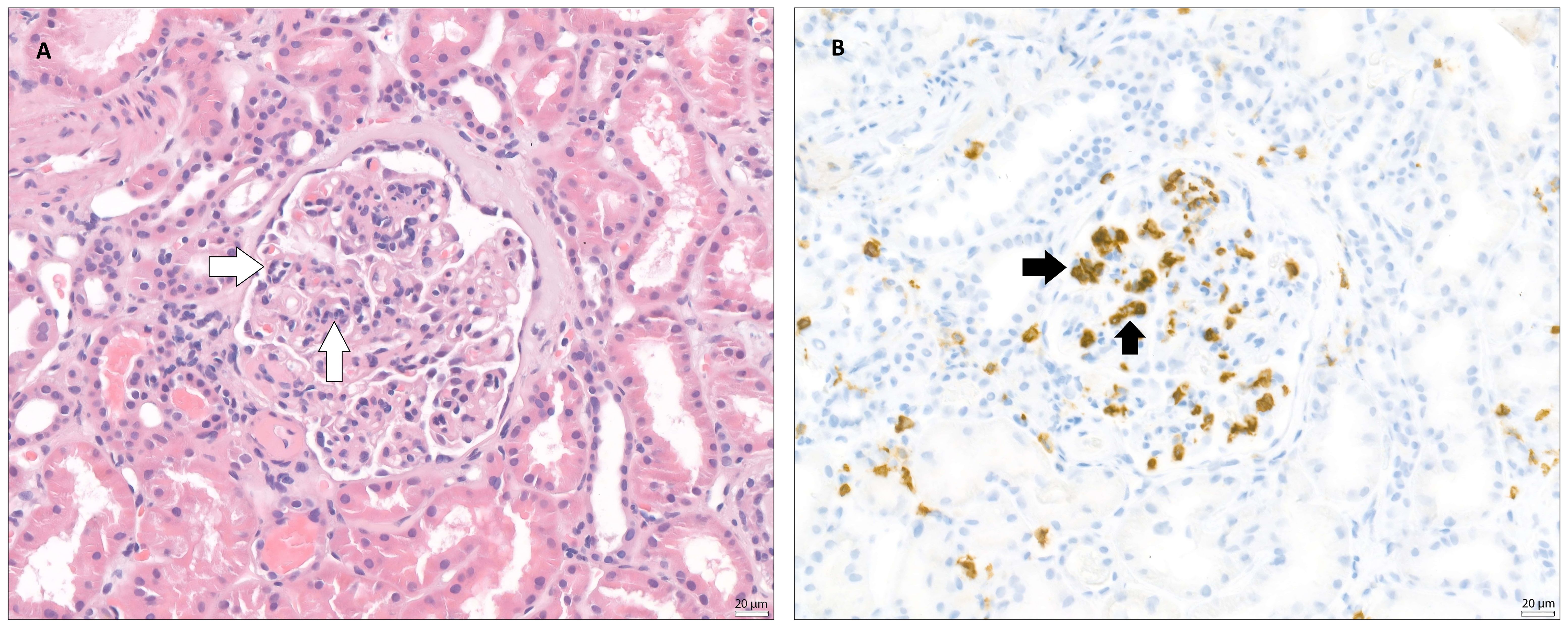 Two panels showing kidney tissue under a microscope. The left panel is stained with H&E, showing a glomerulus with two white arrows highlighting specific areas. The right panel uses immunohistochemistry with brown staining to indicate marker presence, highlighted by two black arrows. Both images show cellular details, with a scale of twenty micrometers.