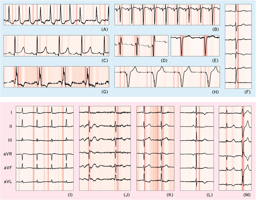 Graphs of electrocardiogram (ECG) readings, labeled A to M, display various heart rhythm conditions, with shaded areas indicating or analysis intervals. The panels include standard leads labeled I, II, III, aVR, aVF, and aVL.