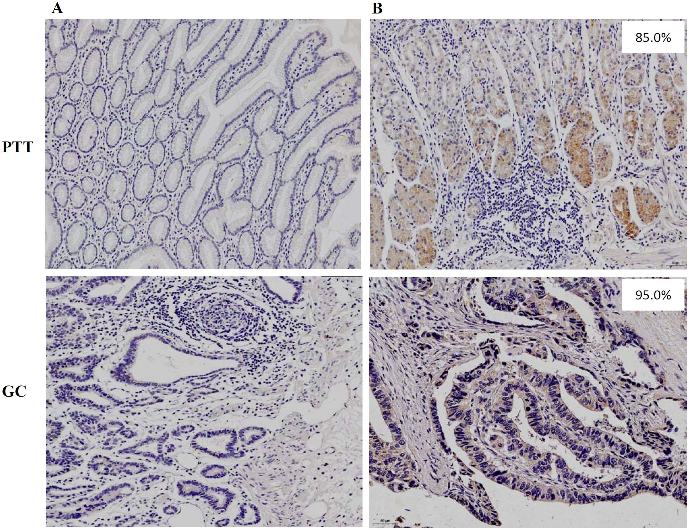 Histological images showing tissue samples. Panel A PTT: upper left without HLA-G stained. Panel B PTT: upper right with 85% HLA-G-positive stained regions. Panel A GC: lower left without HLA-G stained. Panel B GC: lower right with 95% HLA-G-positive stained regions.