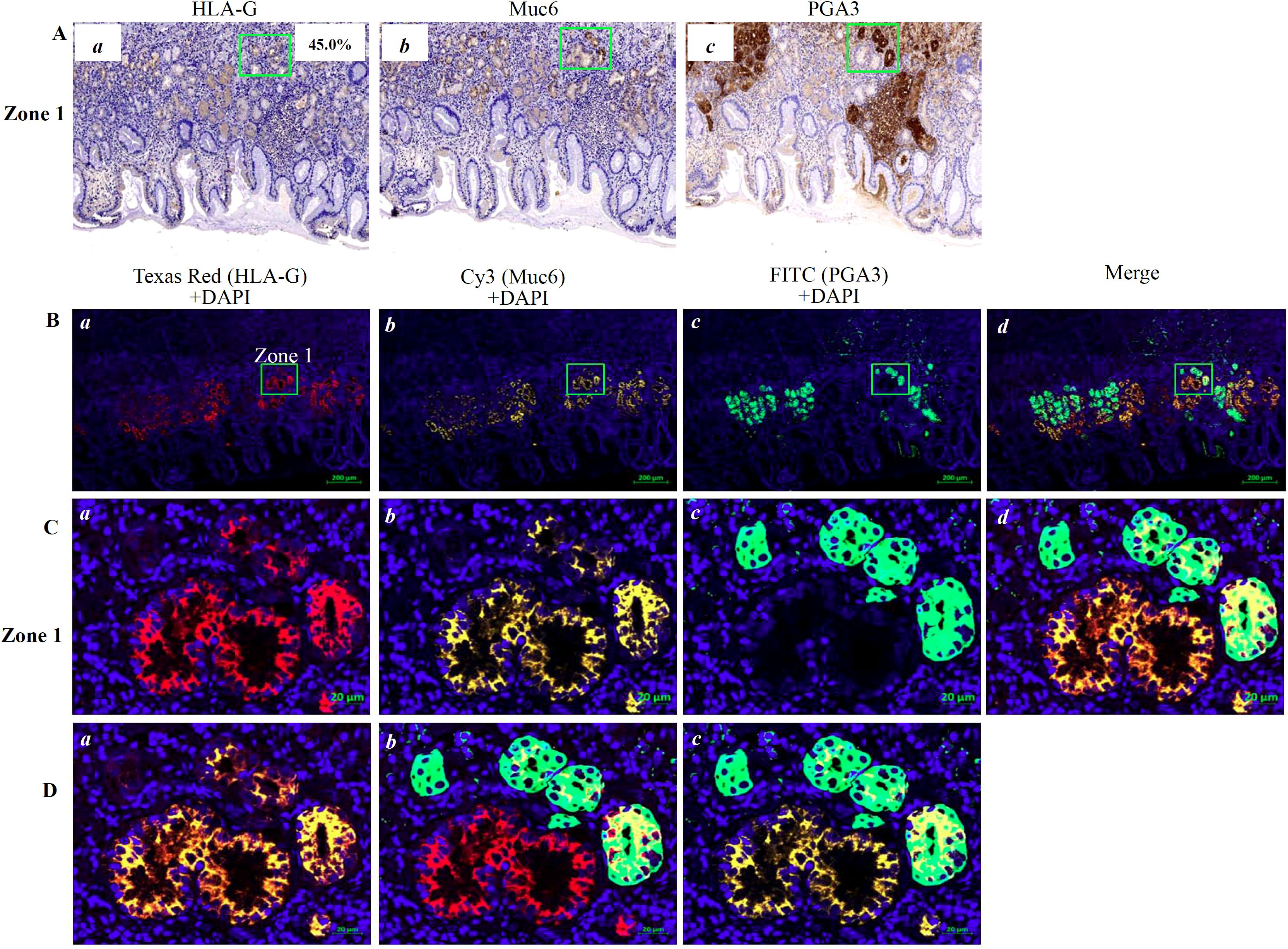Histological analysis of peritumoral tissues of gastric cancer showing expression of HLA-G, Muc6, and PGA3, with corresponding immunofluorescence images. In section A, stained tissue sections highlight zones with different markers. Section B uses Texas Red, Cy3, and FITC, each corresponding to different markers with DAPI for nuclei staining. Sections C and D focus on Zone 1, magnifying individual stained components, highlighting marker co-localization.