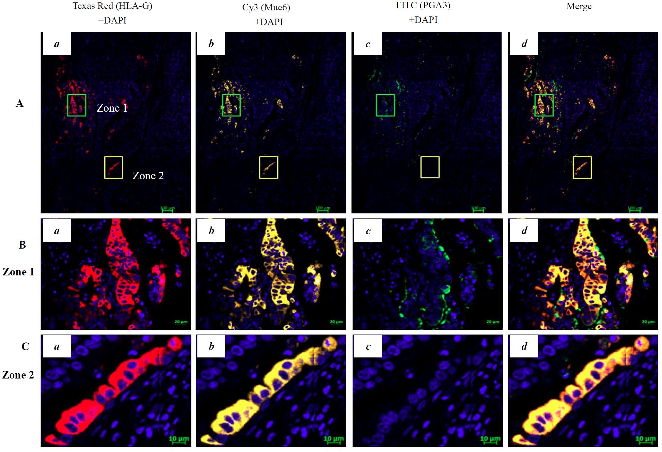 Multiplex immunohistochemistry images showing gastric cancer stained with different markers. Top row (A, a-d) displays zones labeled with Texas Red for HLA-G, Cy3 for Muc6, FITC for PGA3, and a merged view. Middle row (B, a-d) shows a close-up of Zone 1 with the same markers and merged view. Bottom row (C, a-d) highlights Zone 2 with the same labeling approach. Each marker targets specific proteins, highlighted in varying colors against a dark background. Magnification scales are indicated in each set.
