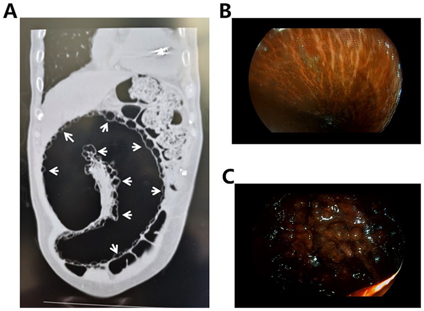 Panel A shows a CT scan with white arrows indicating specific areas within the abdomen. Panel B displays a close-up endoscopic view of the intestinal lining, revealing a textured, reddish surface. Panel C presents another endoscopic image of a darker, glistening surface, showing the intestinal mucosa.