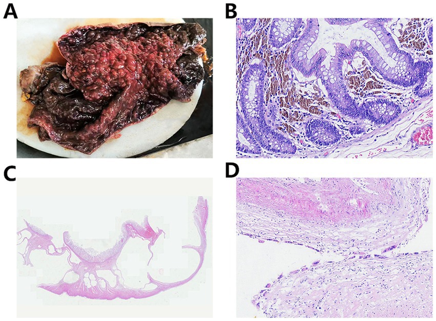 Panel A shows a gross specimen of a colon with a large, dark, nodular mass. Panel B is a microscopic view of colon tissue, stained in purple and showing glandular structures. Panel C features a histological section with a low magnification, displaying numerous variably sized cysts. Panel D presents a higher magnification image of tissue stained pink with visible fibrous and cellular details.
