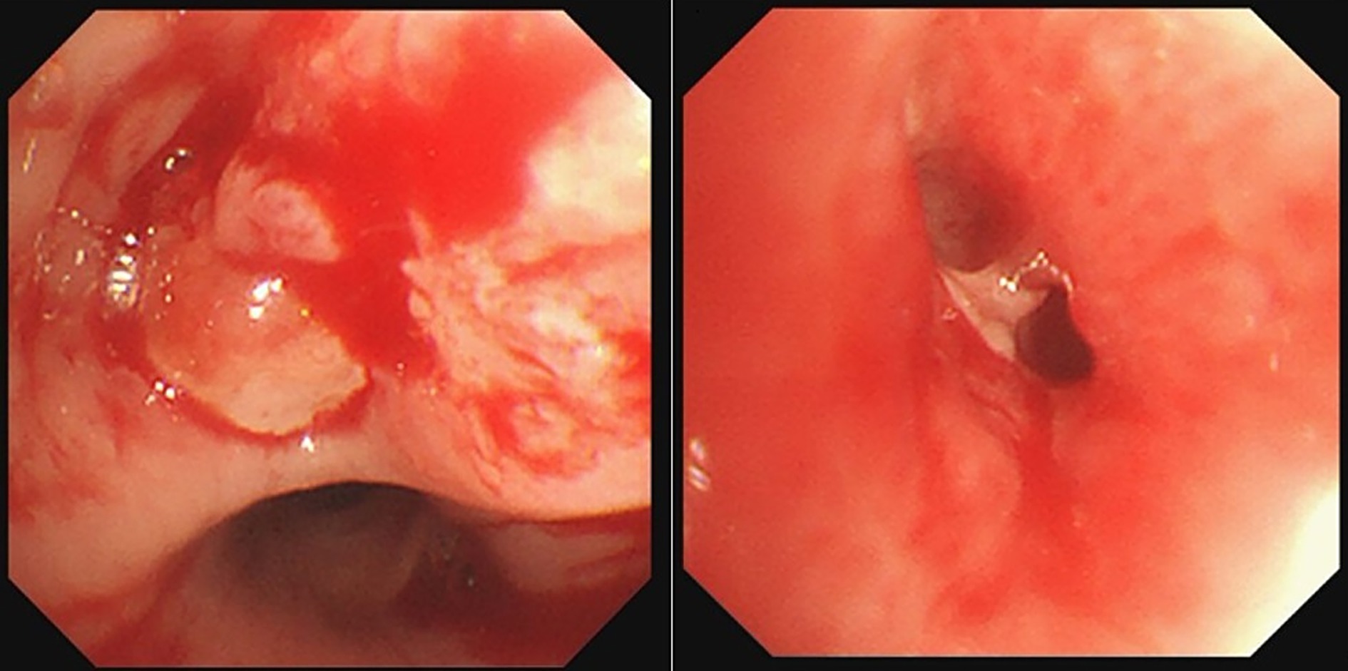 Bronchoscopy revealed an exophytic lesion in the right middle lobe bronchus (RB4) completely obstructed the lumen, Purulent secretion and lumen stenosis were observed in the right lower lobe.