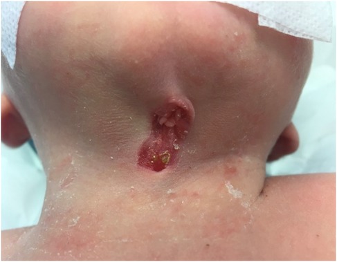 A medical condition on the neck of a baby shows a skin lesion with redness and a small, raised area. The surrounding skin appears dry and slightly irritated. A medical bandage is partially visible.