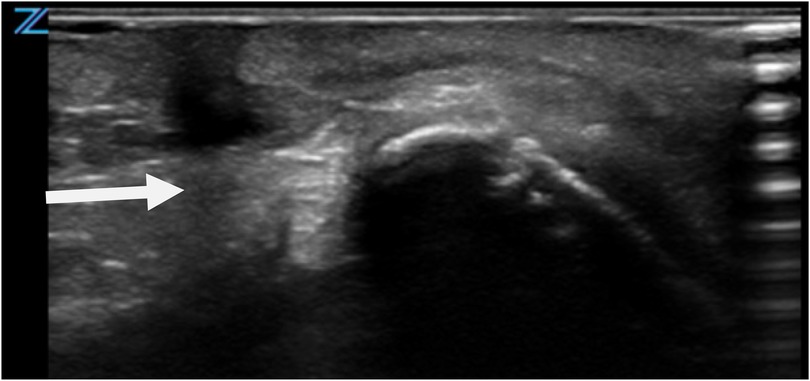 Ultrasound image showing a large heterogeneous hypoechoic region in the neck with irregular margins, indicated by an arrow. The surrounding tissue appears echogenic.