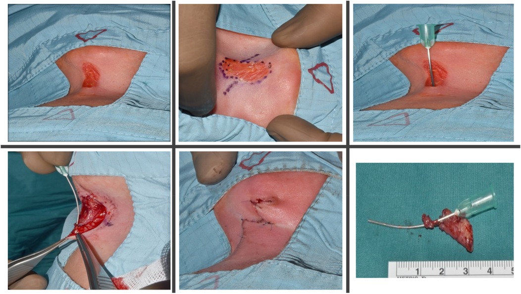 Surgical procedure sequence: an incision on the skin, marked with ink, is expanded and manipulated with instruments to remove tissue. Closure is achieved with stitches. A removed tissue sample on gauze is shown with a measuring scale.