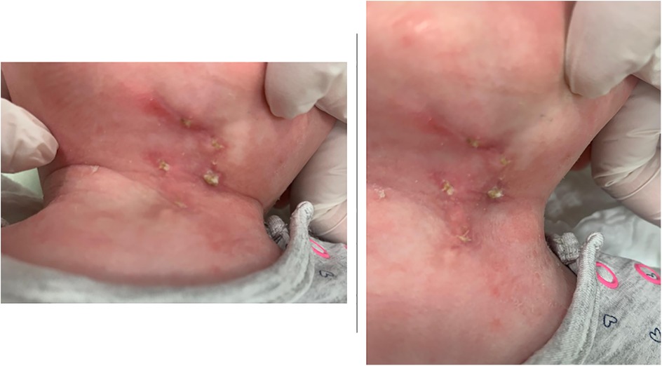 Close-up of an infant's neck showing red, inflamed skin with small yellowish crusts. Gloved hands gently hold the infant's head, suggesting a medical examination.