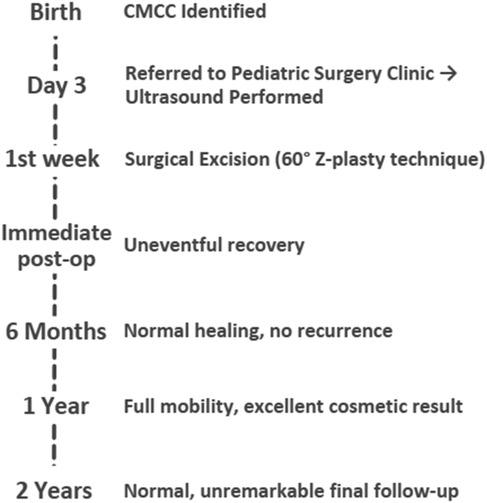 Timeline chart describing the clinical course of a newborn with CMCC. At birth, CMCC was identified. By day three, the infant was referred to pediatric surgery and underwent ultrasound. In the first week, surgical excision using a 60° Z-plasty technique was performed, followed by uneventful recovery in the immediate postoperative period. At six months, healing was normal with no recurrence. At one year, the child had full mobility and excellent cosmetic results. At two years, the final follow-up was normal and unremarkable.
