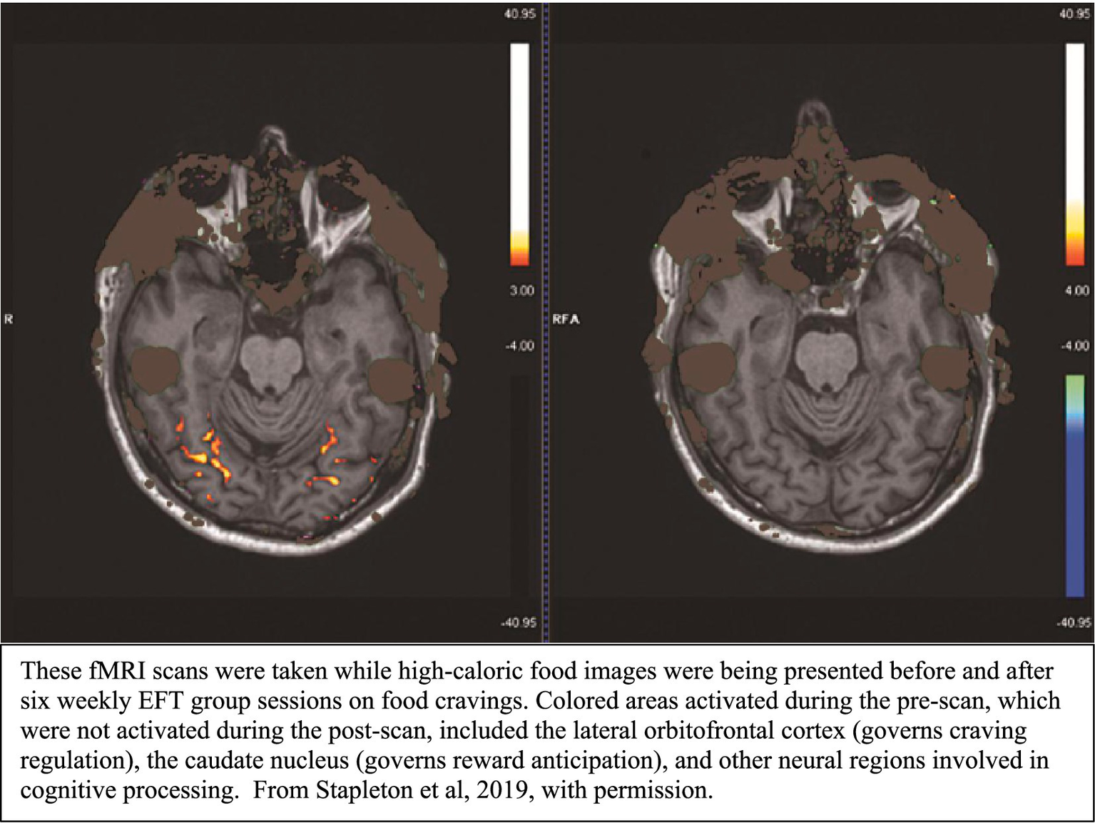 Two brain fMRI scans showing activation differences. The left scan has colored regions indicating activation before six EFT group sessions in response to high-caloric food images. The right scan shows reduced activation post-intervention. Areas involved include the lateral orbitofrontal cortex and caudate nucleus.