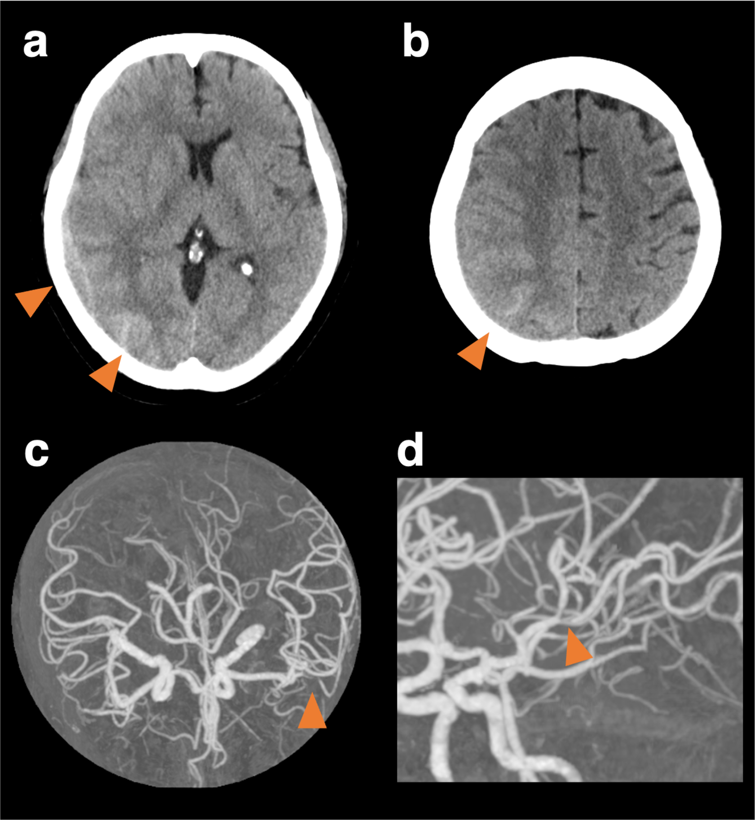 CT brain scans and vascular images in four panels. Panel a and b show axial CT images with orange arrows indicating specific areas in the brain. Panel c displays a circular vascular image with an arrow pointing to a particular vessel. Panel d shows a focused view of the vasculature with an arrow highlighting a vessel of interest.