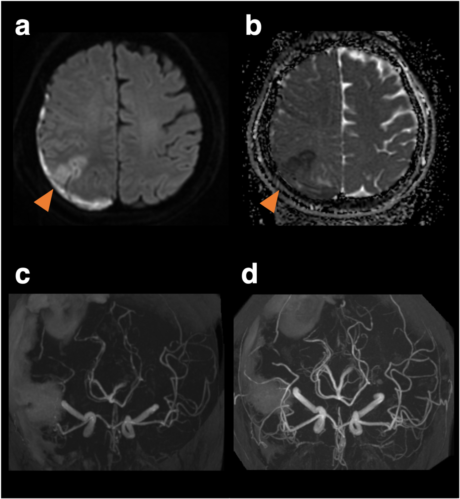 MRI brain images labeled a to d. Image a shows a brain scan with a highlighted area on the left side by an orange arrow. Image b shows a similar scan with a different contrast, also highlighting the area with an orange arrow. Images c and d display angiographic views of the brain's blood vessels from different angles.