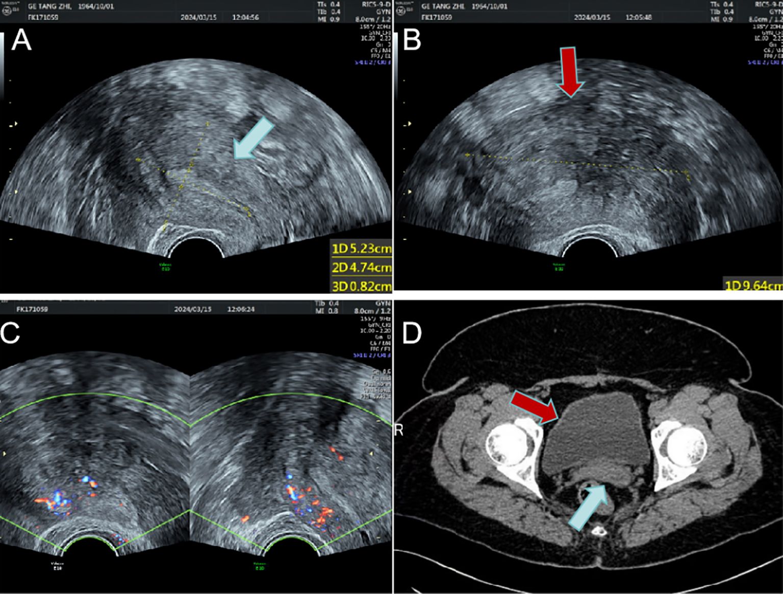 Ultrasound and CT images showing different views of abdominal organs. Image A displays a transverse ultrasound view with a blue arrow indicating a specific area. Image B also illustrates a transverse ultrasound with a red arrow highlighting another region. Image C combines two ultrasound scans, showing color Doppler features. Image D is a CT scan of the pelvis, with a red arrow pointing to the bladder and a blue arrow pointing to the rectum.