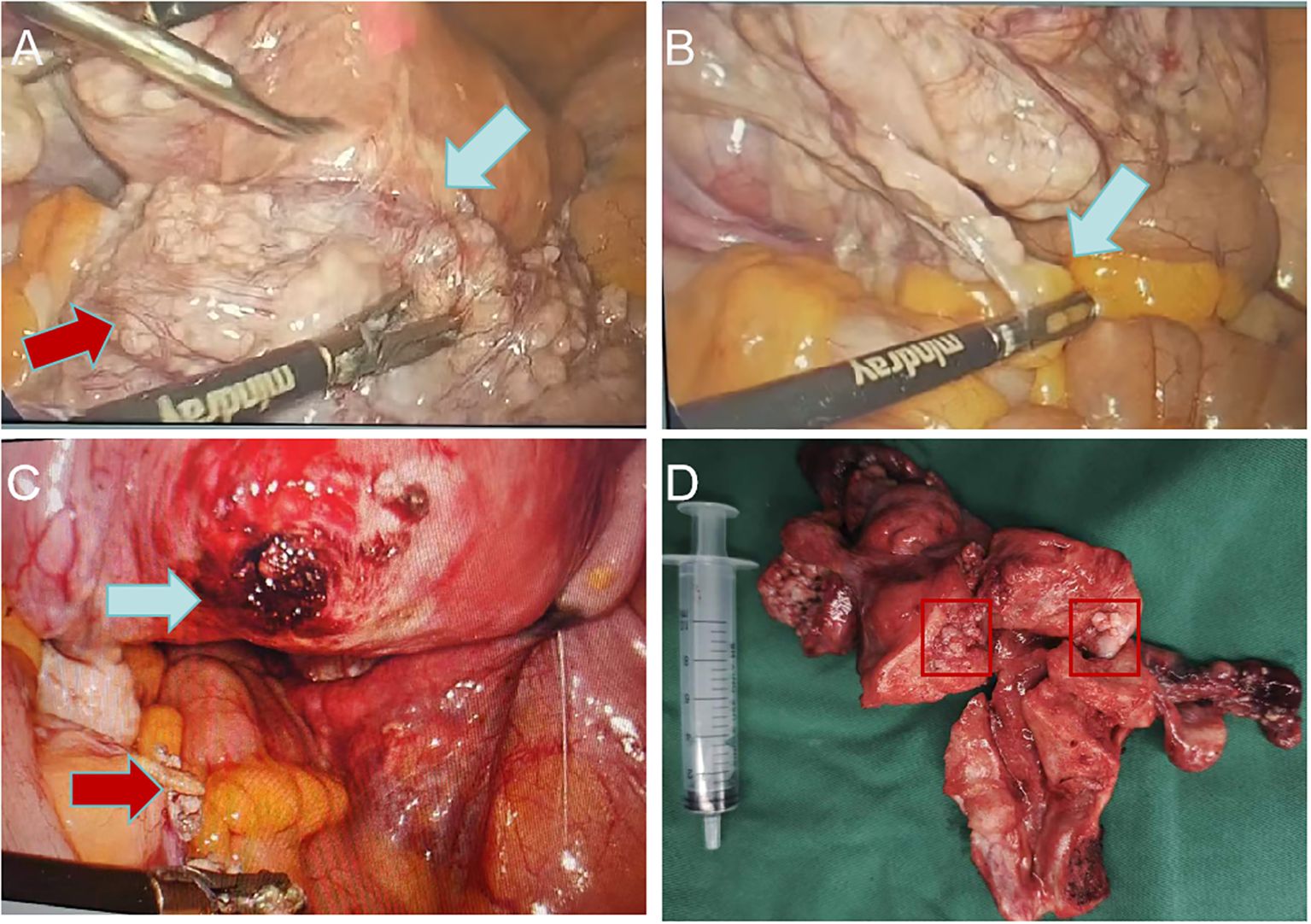 Four images showing surgical procedures and tissue samples. A: Surgical tool near tissue with white arrow indicating a specific area. B: Close-up of tissue with white arrow highlighting a section. C: Wound with red and white arrows indicating specific points. D: Removed tissue samples on a green cloth next to a syringe, with some areas outlined in red.